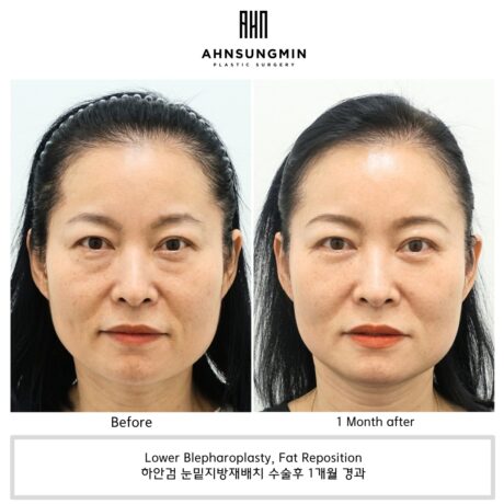 하안검 수술과 애교근육 보존