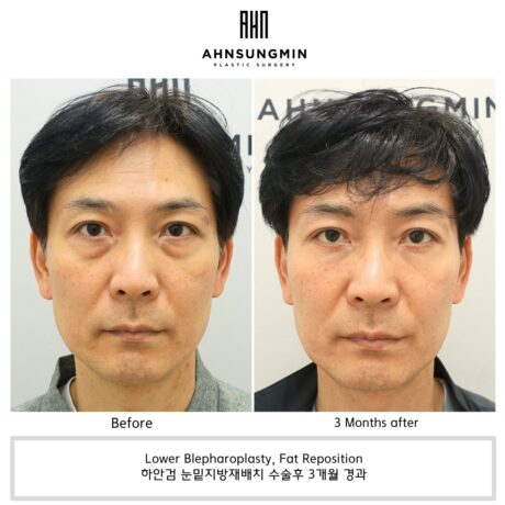 눈밑지방재배치와 하안검 수술 차이점 알아보기