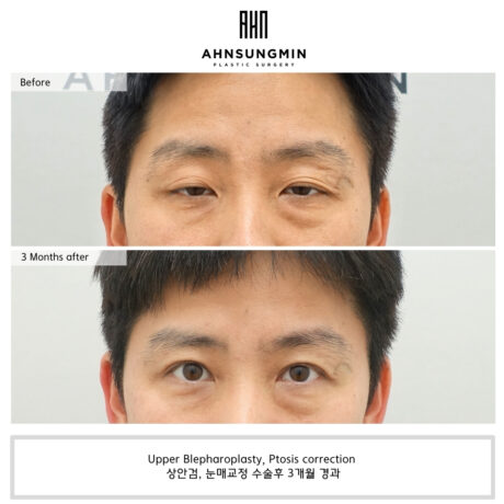 남자 안검하수, 눈이 왜 작을까?