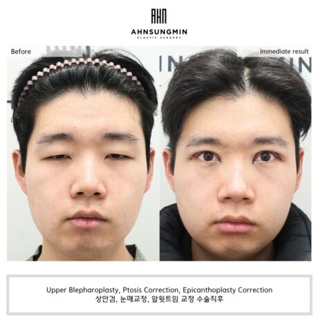 남자 안검하수 ‘눈이 커지고 싶어요’