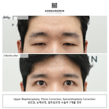남자 눈매교정 전후 비교 사례 및 수술 방법에 대해 알아보기