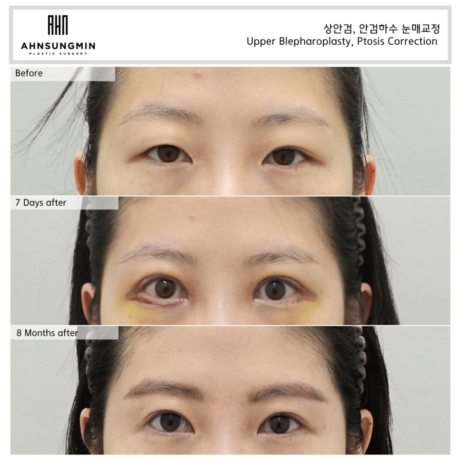 절개 눈매교정과 비절개 눈매교정 중 나에게 맞는 방법은?