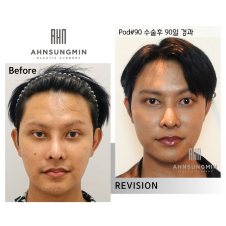 두줄따기 개념과 이를 교정하는 쌍꺼풀 재수술 알아보기