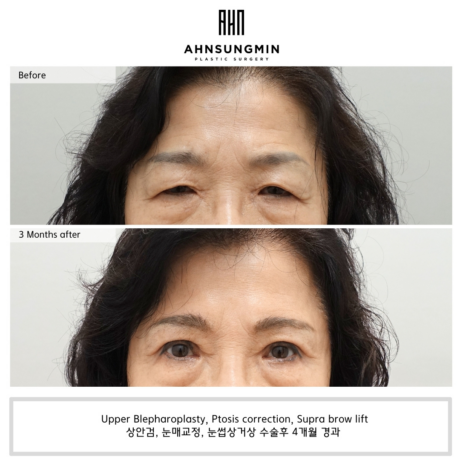 상안검과 눈밑지방재배치, 중년눈성형 고려해야 할 점